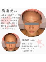 ライゼ(REISE)/ビフォーアフター【小顔/美白】