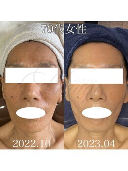 ニュアージュ(Nuage)/70代女性・6ヶ月の変化