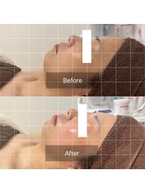 天使の艶肌/ハーブピーリング before/after