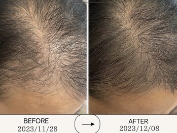 アリアンド(ari.and)/プロセル育毛促進　症例写真