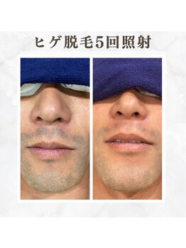ボゴス 天白店(BOGOSS)/【ヒゲ脱毛】施術写真