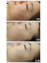 ラミーユ(La Miu)/ハーブピーリング/京都山科椥辻