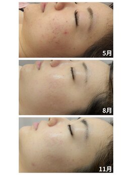 ラミーユ(La Miu)/ハーブピーリング/京都山科椥辻