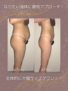 トータルエステティック レイ(Lay)/ポッコリお腹→美くびれ！