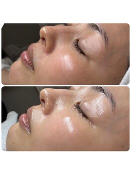 エミレーブ シロカネ(Hemireve Shirokane)/今の肌に必要なケアを見極めます