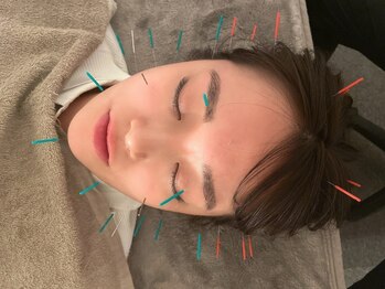 ムゲン(MUGEN)の写真/【大人気◆美容鍼¥5500～】エイジングケアからトーンアップ/眼精疲労/肩こり等にも◎一度ご体験ください!!