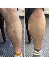 シャンティ(Shanti)/メンズ脱毛