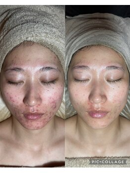 フィール 茂原店(Feel)/ハーブピーリング剥離なしニキビ