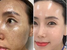 エミニナル(EMININAL)/【フェイシャル】変化