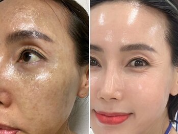 エミニナル(EMININAL)/【フェイシャル】変化