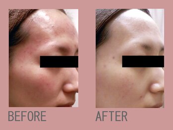 ジュリア オージェ 四条河原町店/ビフォーアフター（美白美肌）