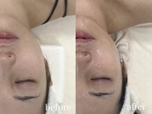 ルーム バイ マナ(room by 麻奈)/光フェイシャル