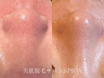 スピカ(SPICA)/固くなったザラザラ