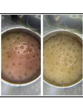 ハルハル(Haru Haru)/毛穴開きケア