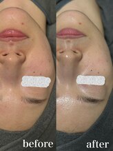 エードット スパ アンド ハーブ(a.spa & herb)/ハーブピーリング