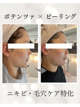 リノ ショウナン(LINO SHONAN)/before→after