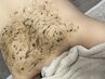 【BODY☆背中ニキビケア】ソフトハーブピーリング(剥離なし)背中上部
