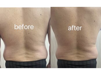 ヤン リン 整体(Yang Ling 整体)/メンズの背中もキュッと引き締め