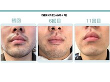 ネクストプラス 大分別府店(NEXT+)/【ヒゲ脱毛】ビフォーアフター