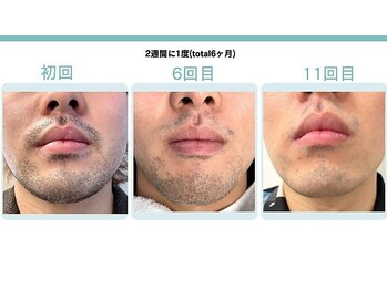 ネクストプラス 大分別府店(NEXT+)/【ヒゲ脱毛】ビフォーアフター