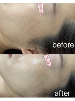 ホッコリ 段原店(HOKKORI)/効果実感No.1BBL光フェイシャル