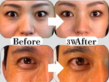 ビースキン 広島(BE:SKIN)/塗るリフトアップ
