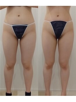 クレール アオヤマ(CLAIRE AOYAMA)/1ヵ月お腹～下半身サイズダウン