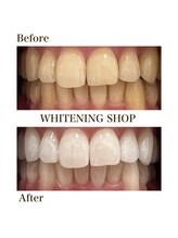 ホワイトニングショップ 岩出店(WHITENINGSHOP)/フリーパスBefore/After