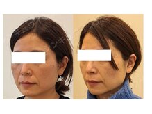 鍼灸院アゼ(AZE)/お顔の変化