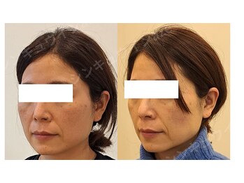 鍼灸院アゼ(AZE)/お顔の変化