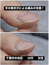 巻き爪じゅん 千葉駅前店/手の巻き爪による痛みから解放