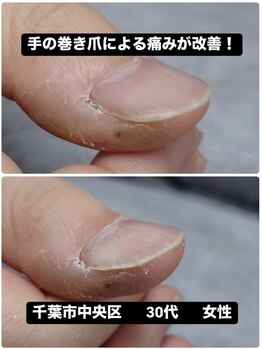 手の巻き爪による痛みから解放