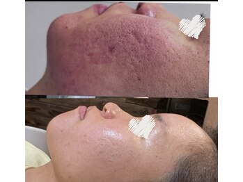 モモン シャルール/当店のハーブピーリング☆