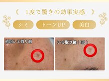 ルネ(Rune)の雰囲気（シミを薄くしたい方おすすめ！ダウンタウンなし本格的にシミケア）