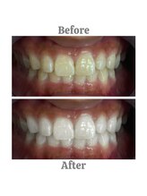 エクシアホワイトニング 相模大野店/ビフォーアフター