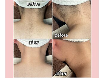 浜松富塚ベルミーランド/脱毛Before→After