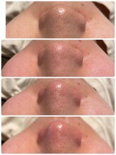 ネムレル森(Nemureru森)/毛穴洗浄【水巻/八幡西区/折尾】