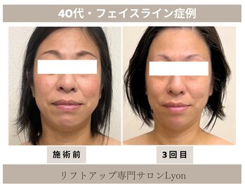 リヨン(Lyon)/（40代）食いしばり・輪郭改善