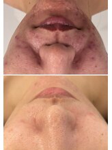 美時雨/ニキビにお悩みの方！