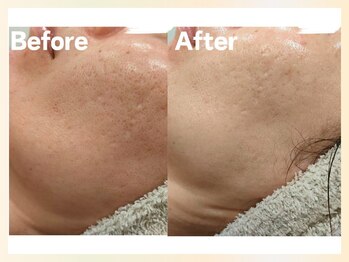 ソウナ(SONA)/カーボキシーと光フェイシャル