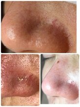 ミント/お肌の薄い場合のお鼻