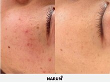 ナルムフェイシャル 代々木(NARUM facial)/白玉ピーリング/水光ピーリング