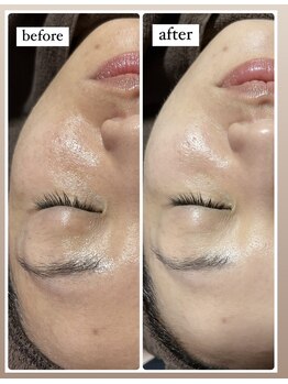 薫風/毛穴洗浄/30代