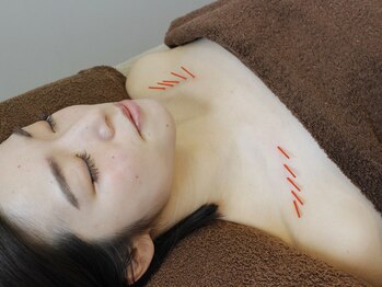 ソリーシェ鍼灸院(SORRISCE)/お身体の美容鍼も大人気♪