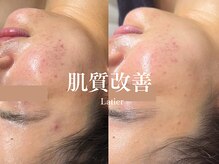 ラティエ(Latier)/ハーブピーリング1回目お客様♪