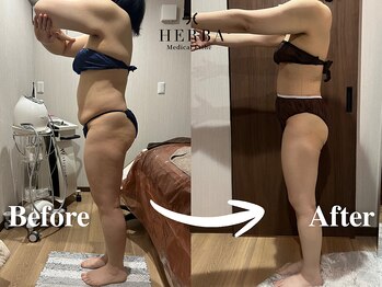 ヘルバ(HERBA)/痩身