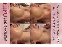 リフトアップには【切らない小顔リフト】1度でここまで変わる！