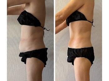 アイリーボーテ 東大阪(アイリーBEAUTE)/60代　お腹12回結果