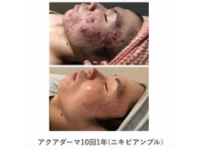 イエナ(IENA)の雰囲気(ニキビアンプル深層導入で人生が180度変わりました!)