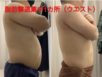 ちゅるん肌ドットコム 喜連瓜破店(ちゅるん肌.com)/ 集中1か所1回の変化